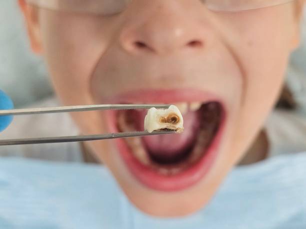 Best Emergency Wisdom Teeth Removal in Chalfant, CA